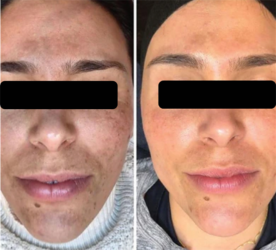 Vi Peel Treatment Jan 2024