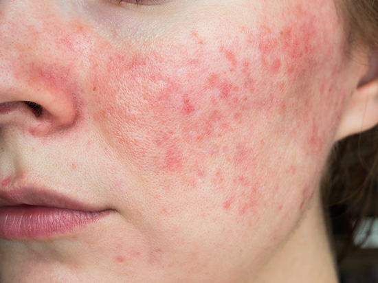 Kiki Skin And Body Spa Andover Ma Blog Rosacea
