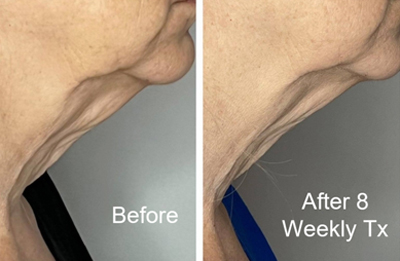 Kiki Skin Spa Venus Legacy Neck Treatments