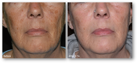 Before and after comparison of facial skin rejuvenation treatment showing improved texture and tone after four sessions.