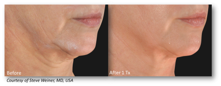 Before and after comparison of skin tightening treatment showing improved skin firmness and reduced sagging on lower face and neck area.