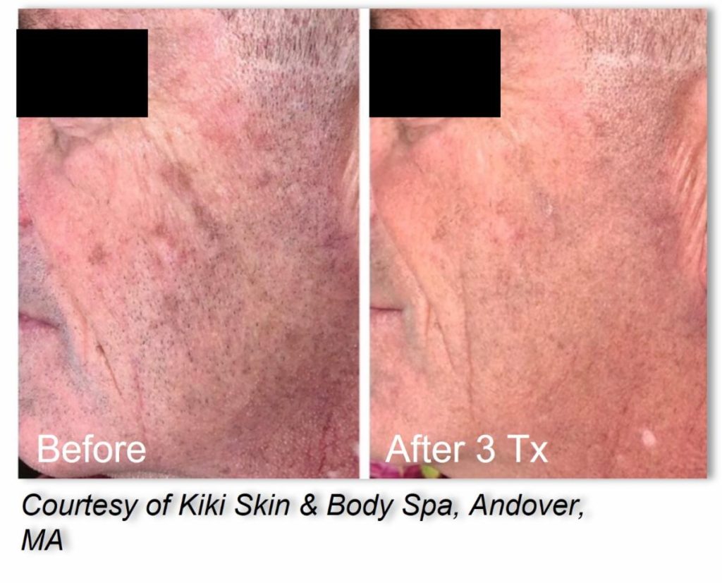 LaseMD laser skin treatment at Kiki Skin & Body Spa